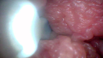 Endoscope Camera Shows the Most Sensitive Parts of the Penis Educational Video