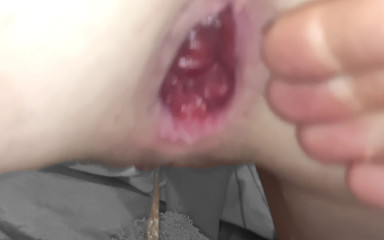 I Had My 21f Whore Asshole Punch Fisted Whilst I Squirted Repeatedly